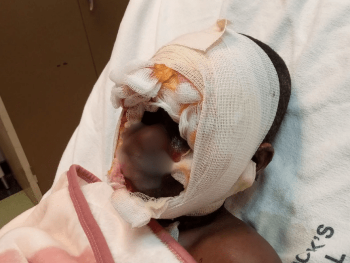 Students Suffer Severe Burns While Performing School Chores