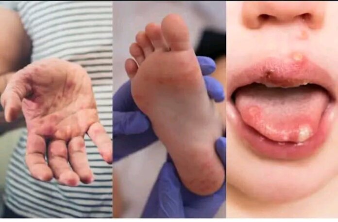 Foot And Mouth Disease An outbreak of Foot and mouth disease has been confirmed in the Free State province.