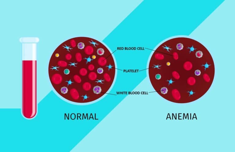 need to know about iron deficiency anemia